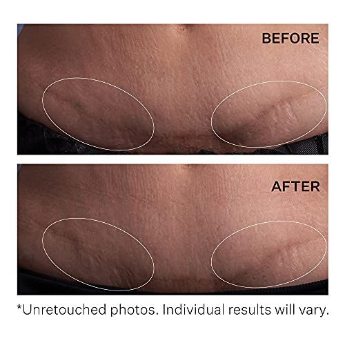 StriVectin Anti-Wrinkle SD Advanced PLUS Intensive Moisturizing Concentrate for Wrinkles and Stretch Marks with Collagen-Targeting Technology, 4 Fl Oz
