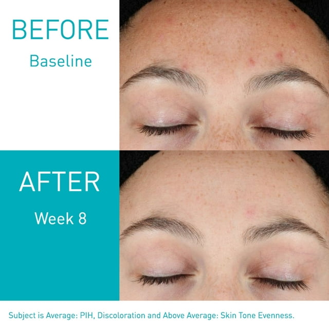 CeraVe Acne Resurfacing Retinol Face Serum with Retinol and Niacinamide for Acne Prone Skin, 1 fl oz