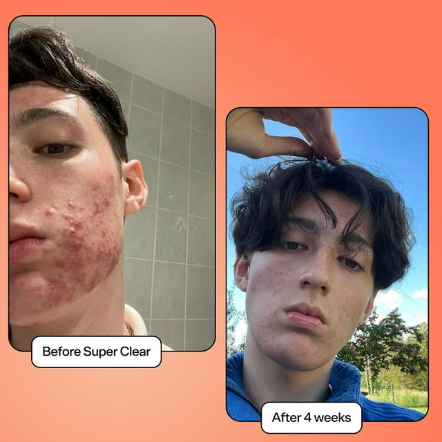 Bubble Skincare Super Clear Acne Treating Serum, All Skin Types, Acne Prone Skin, 1 fl oz / 30ml